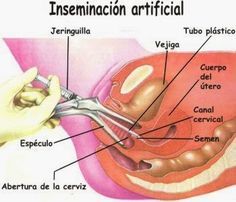 INFERTILIDAD, ABORTO EXPONTANEO Y RECURRENTE