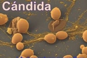 Candidiasis