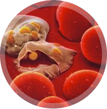 Malaria