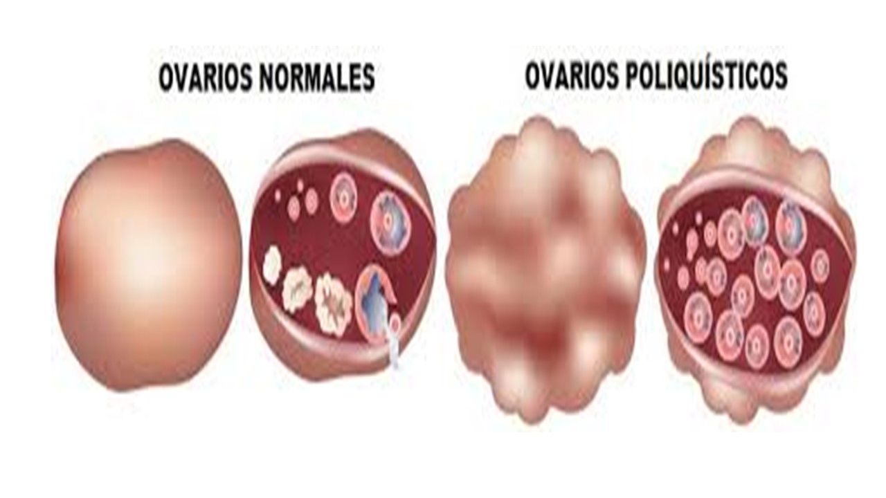 Sesión 42: Enfermedades endócrinas y endometriosis