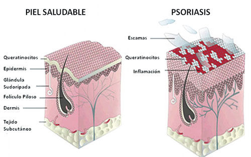 Psoriasis Características
