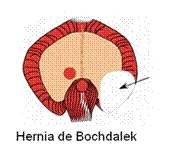 Es la hernia diafragmática mas común