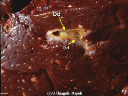 DICROCOELIUM DENDRITICUM Adultes dans les canaux biliaires Angiocholite Pas d'épaississement de la paroi comme chez fasciola