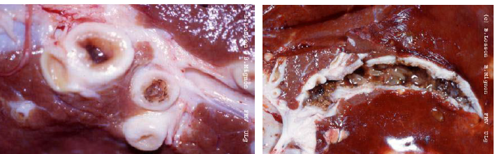 FASCIOLA HEPATICA Hyperplasie des canaux biliaires avec parfois calcification