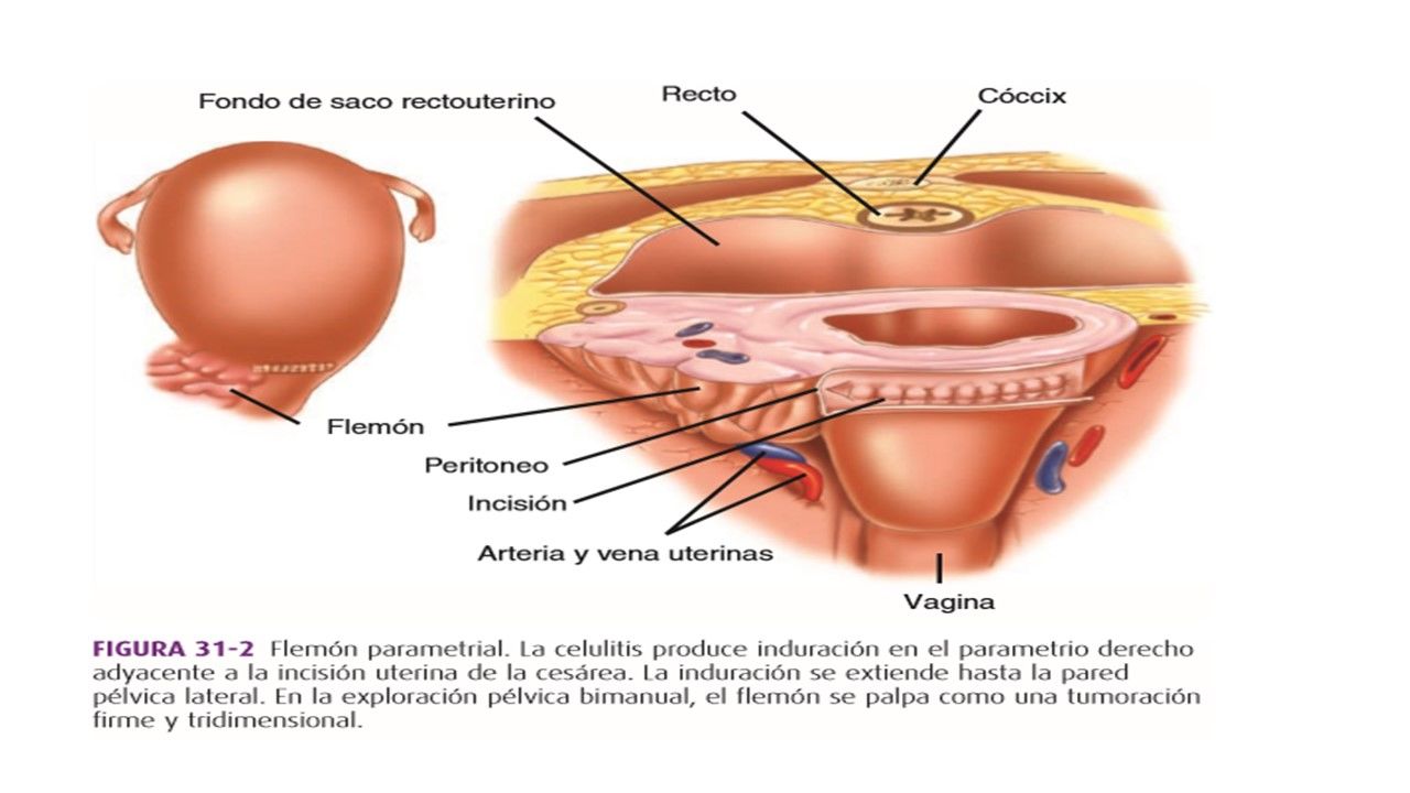 Sesión 15: Puerperio, infección puerperal y trastornos puerperales diferentes a la infección