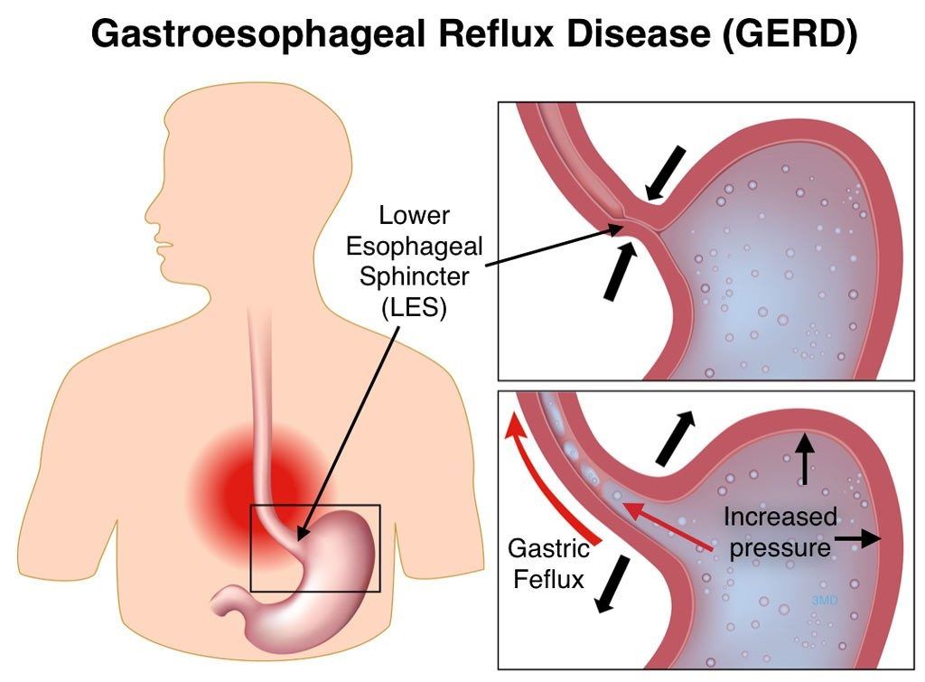 Gastroesophageal reflux disease(GERD): Recovery For Adult Patients