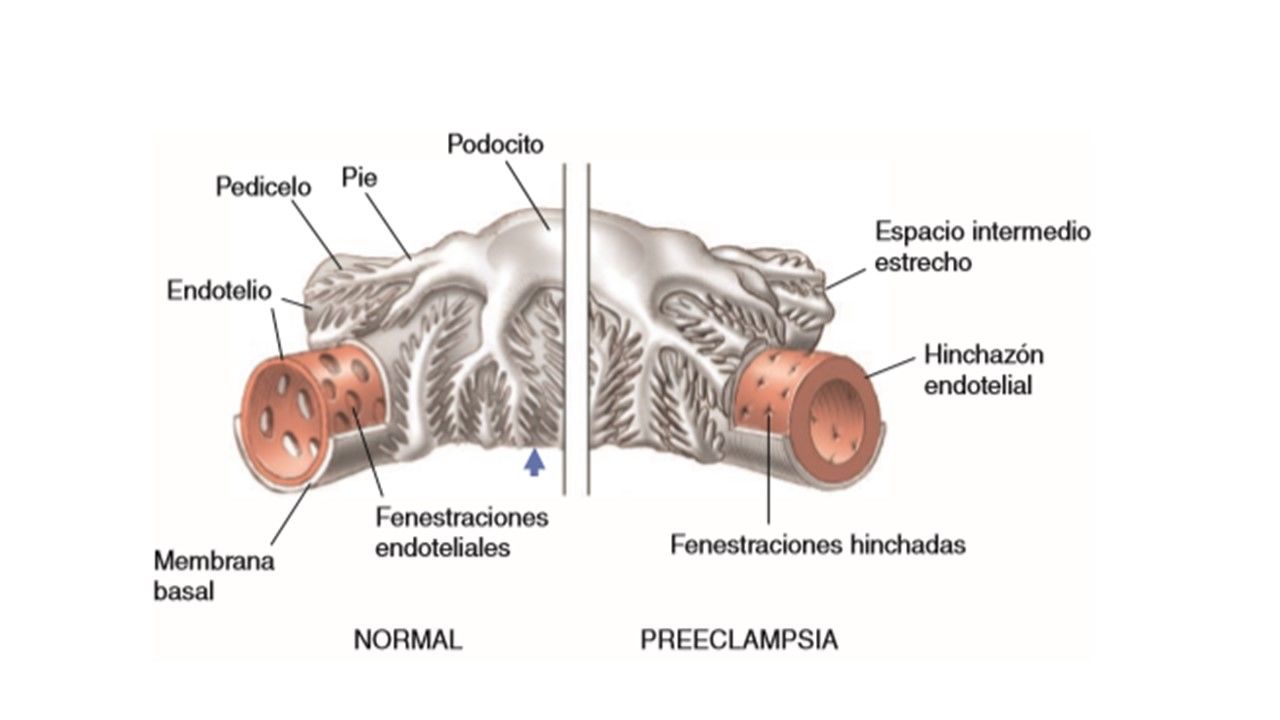 Sesión 18: Enfermedad Hipertensiva del embarazo