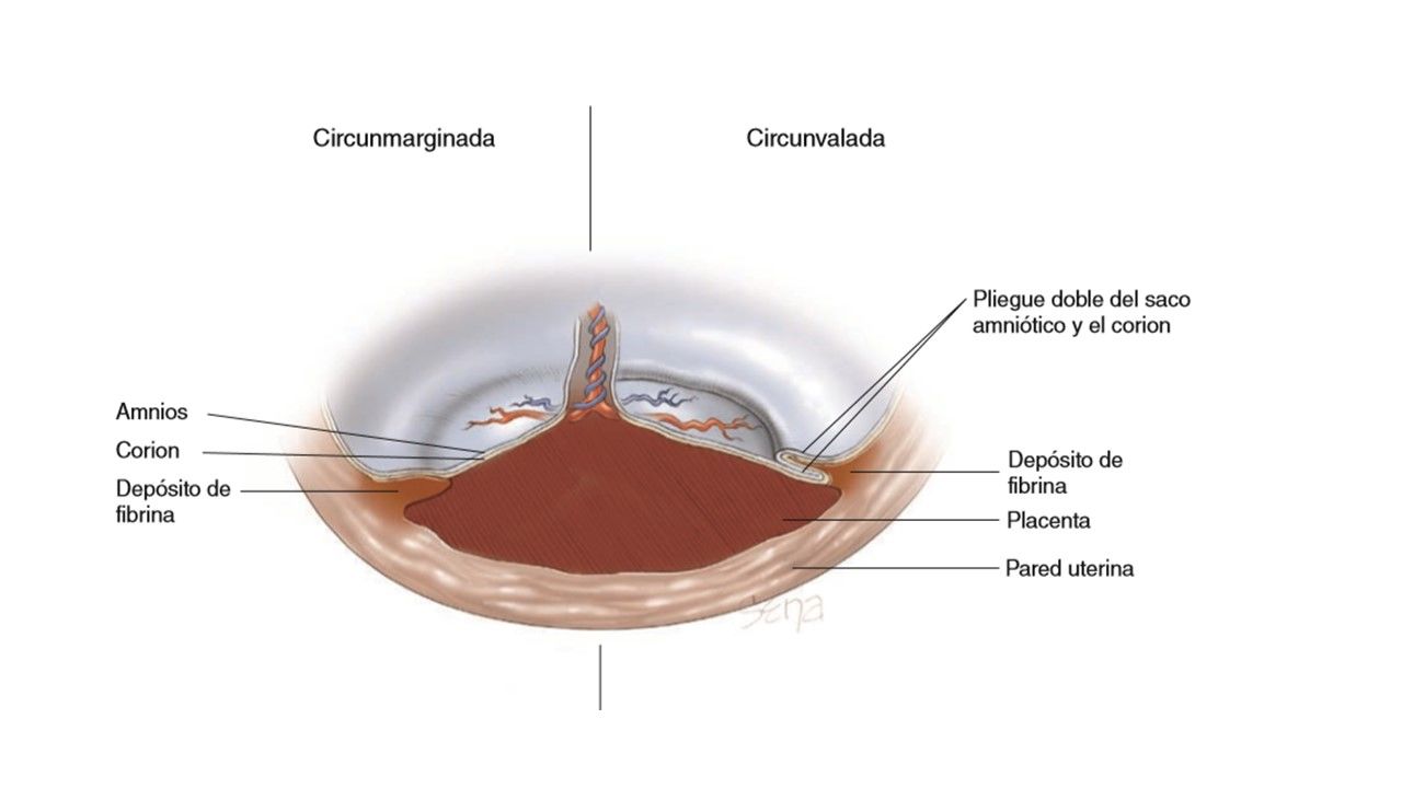 Sesión 17: Anomalías de las membranas fetales y de la placenta
