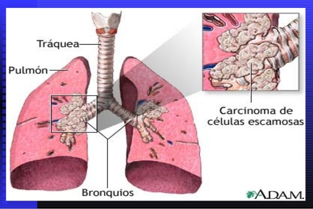 Cáncer de pulmón y tabaco en Asturias. Un estudio de casos y controles.