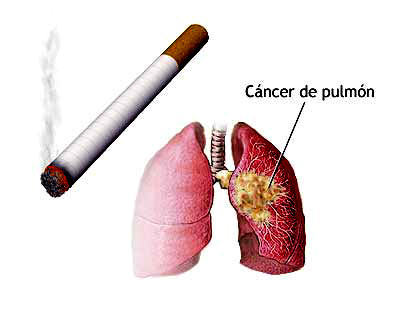 Cáncer de pulmón y tabaco en Asturias. Un estudio de casos y controles.