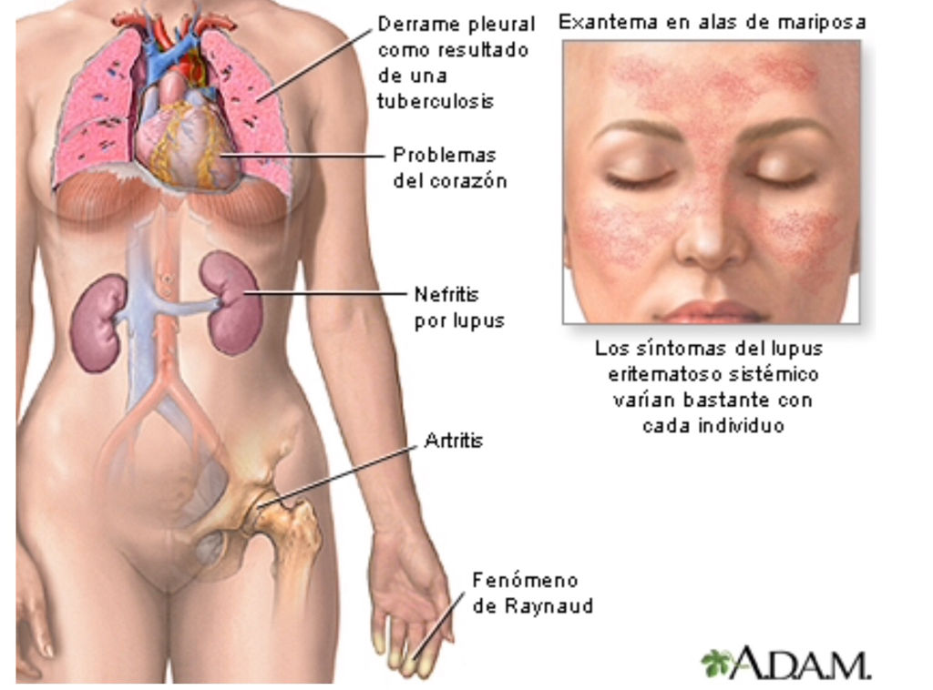 Lupus Eritematoso Sistemico (LES)