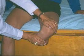 INTERVENCIONES DE ENFERMERIA EN DIABETES MELLITIS PARA PACIENTES CON AMPUTACION