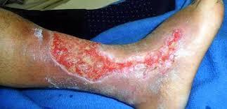 INTERVENCIONES DE ENFERMERIA EN DIABETES MELLITIS PARA PACIENTES CON AMPUTACION