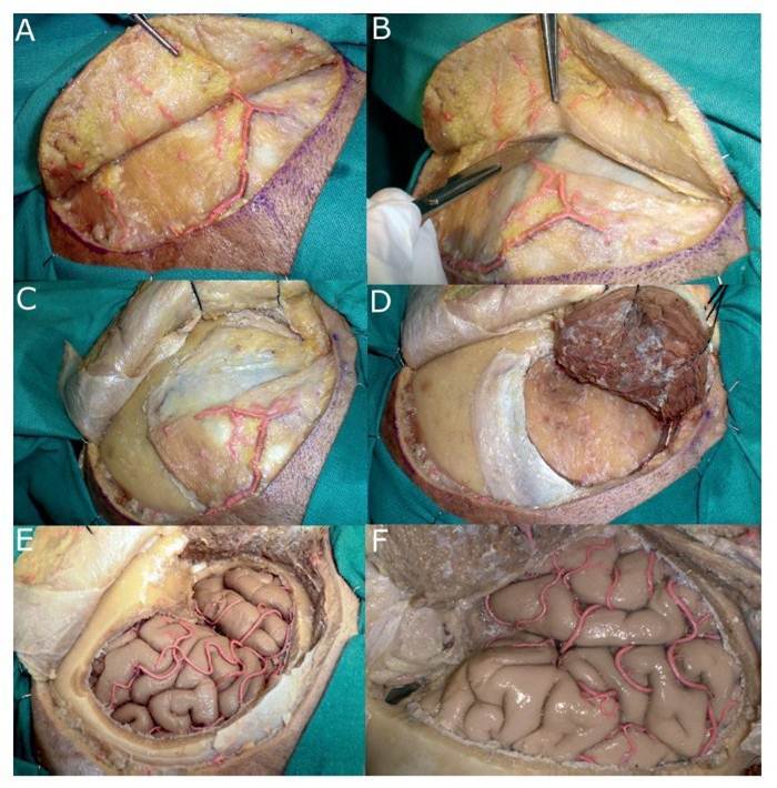 CUIDADOS DE ENFERMERÍA EN POSTOPERATORIO DE NEUROCIRUGÍA