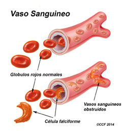 Anemia de células falciformes o drepanocítica