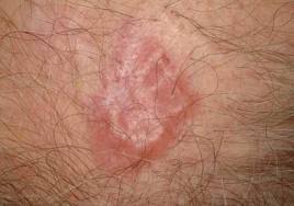 TRABAJO DE TERAPIA DERMATOLOGICA:CANCER DE LA PIEL