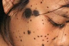 TRABAJO DE TERAPIA DERMATOLOGICA:CANCER DE LA PIEL
