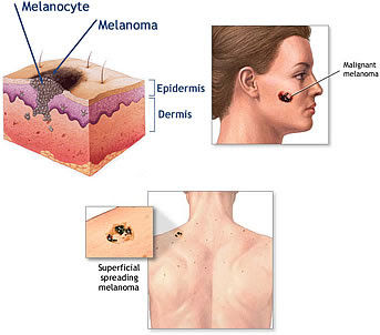 TRABAJO DE TERAPIA DERMATOLOGICA:CANCER DE LA PIEL
