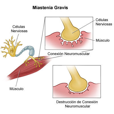 MIASTENIA GRAVIS FISIOPATOLOGIA