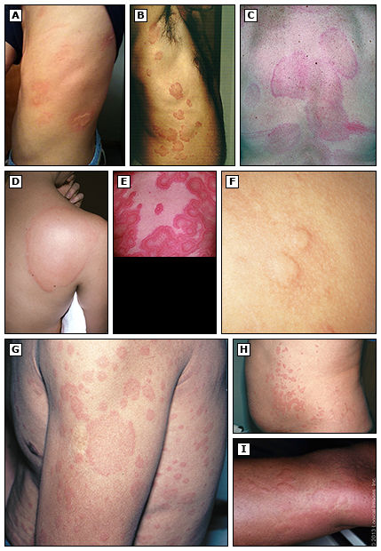 APLICACIÓN CLÍNICA DE ANTIHISTAMINICOS EN EL TRATAMIENTO DE URTICARIA