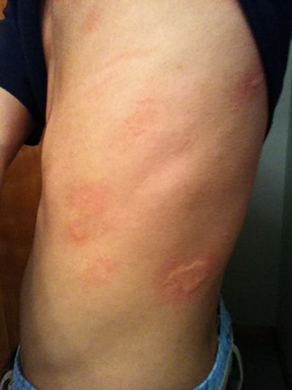 APLICACIÓN CLÍNICA DE ANTIHISTAMINICOS EN EL TRATAMIENTO DE URTICARIA