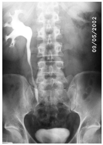 Malformaciones congénitas del riñón y del tracto urinario
