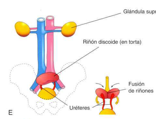 Malformaciones congénitas del riñón y del tracto urinario