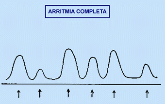 Insuficiencia cardiaca congestiva
