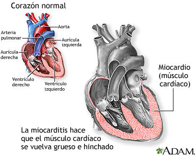 Insuficiencia cardiaca congestiva