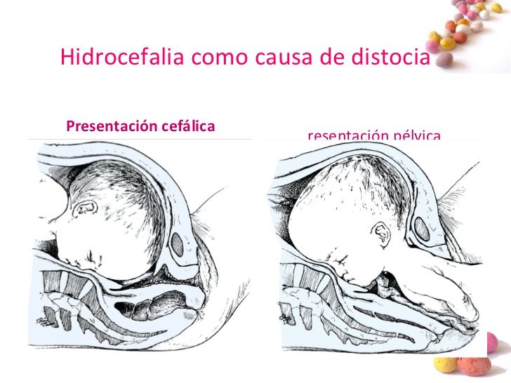 Distocias por Anomalías en las Fuerzas de Expulsión de la Presentación, de Posición o del Desarrollo