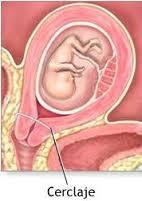 SESIÓN 16. Embarazo en los extremos de la vida. Aborto. Embarazo ectópico.