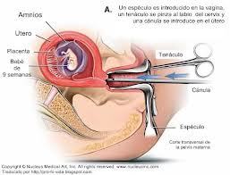 SESIÓN 16. Embarazo en los extremos de la vida. Aborto. Embarazo ectópico.