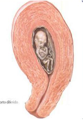 SESIÓN 16. Embarazo en los extremos de la vida. Aborto. Embarazo ectópico.