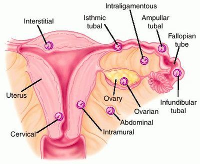 SESIÓN 16. Embarazo en los extremos de la vida. Aborto. Embarazo ectópico.