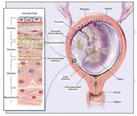 SESIÓN 17. Anomalías de las membranas fetales y de la placenta
