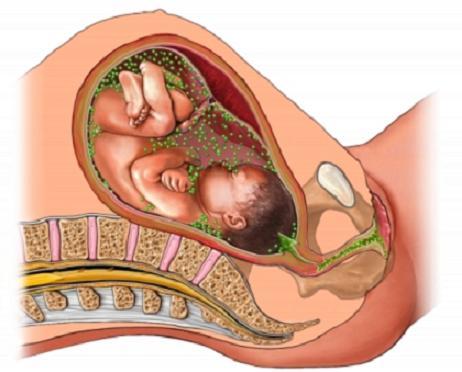 SESIÓN 17. Anomalías de las membranas fetales y de la placenta
