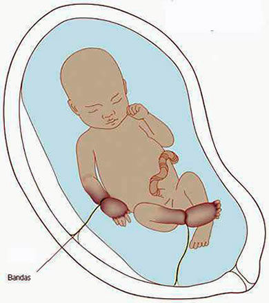 SESIÓN 17. Anomalías de las membranas fetales y de la placenta