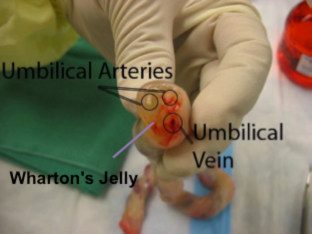 SESIÓN 17. Anomalías de las membranas fetales y de la placenta