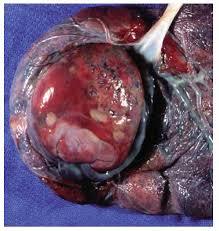 SESIÓN 17. Anomalías de las membranas fetales y de la placenta
