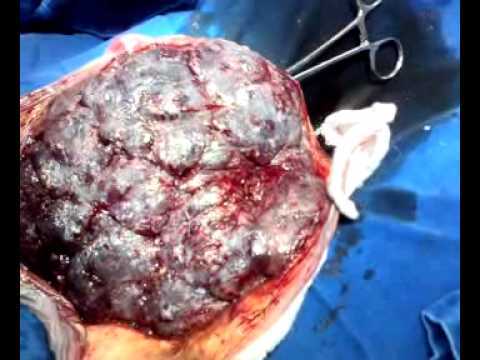 SESIÓN 17. Anomalías de las membranas fetales y de la placenta
