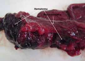 SESIÓN 17. Anomalías de las membranas fetales y de la placenta