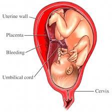 SESIÓN 17. Anomalías de las membranas fetales y de la placenta