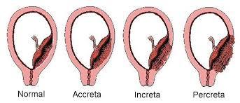 SESIÓN 17. Anomalías de las membranas fetales y de la placenta