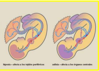 SESIÓN 11. Distocias por Anomalías de las fuerzas de expulsión, Presentación, Posición o Desarrollo.