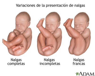 SESIÓN 11. Distocias por Anomalías de las fuerzas de expulsión, Presentación, Posición o Desarrollo.