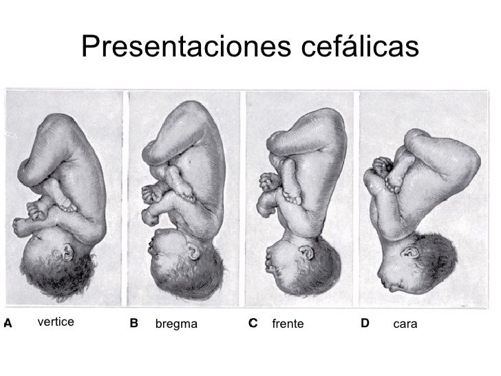 SESIÓN 11. Distocias por Anomalías de las fuerzas de expulsión, Presentación, Posición o Desarrollo.