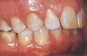 ENVEJECIMIENTO DE LOS TEJIDOS DENTALES