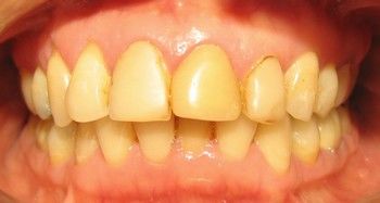 ENVEJECIMIENTO DE LOS TEJIDOS DENTALES