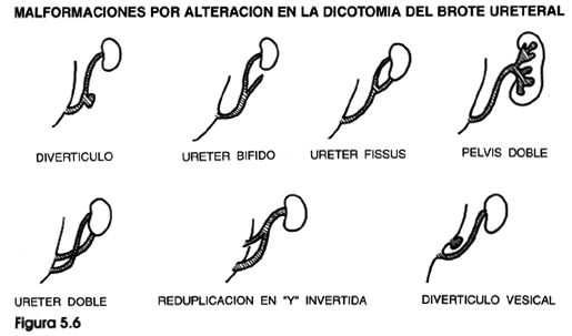 MALFORMACIONES URETERALES