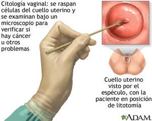 Enfermedad intraepitelial de cervix, vagina y vulva.